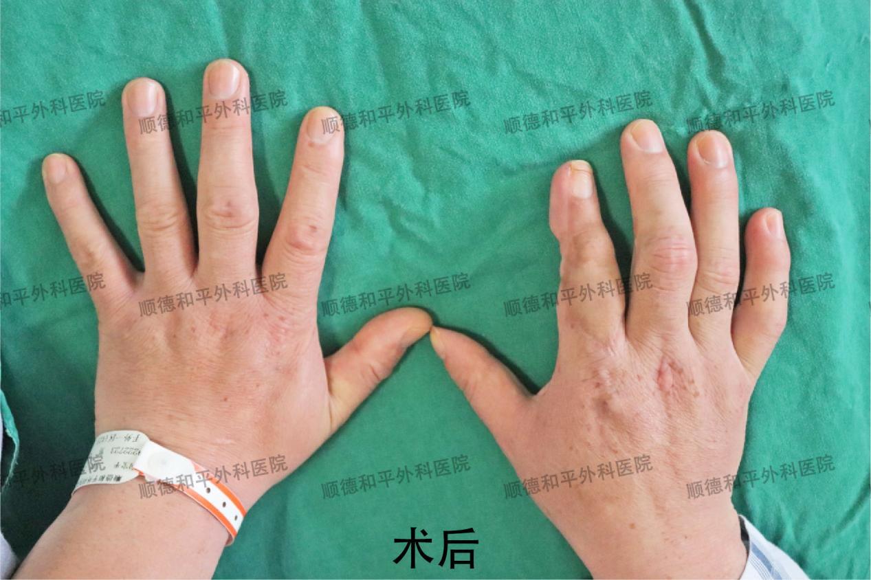 新疆患者失去手指心生自卑，遠赴廣東手指再造＿手外科醫(yī)院咨詢(圖3)