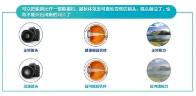 愛(ài)爾眼科：白內(nèi)障不會(huì)“缺席”只會(huì)“遲到”？(圖1)